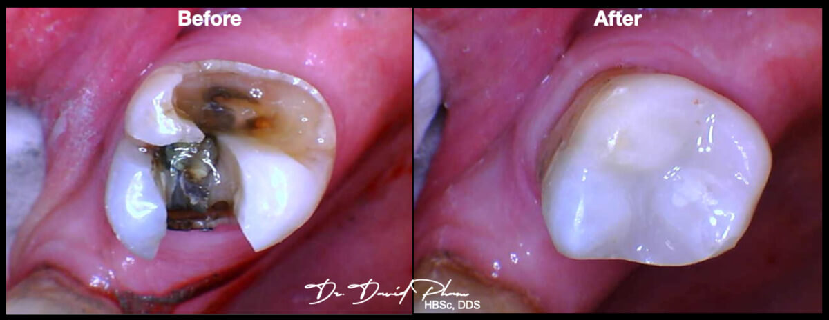 cavity before and after