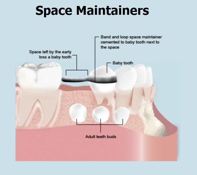 Baby Teeth Space Maintainer - Arbo Dental Care - Bradford