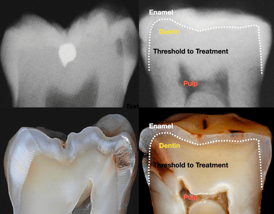 xray of teeth with a cavity