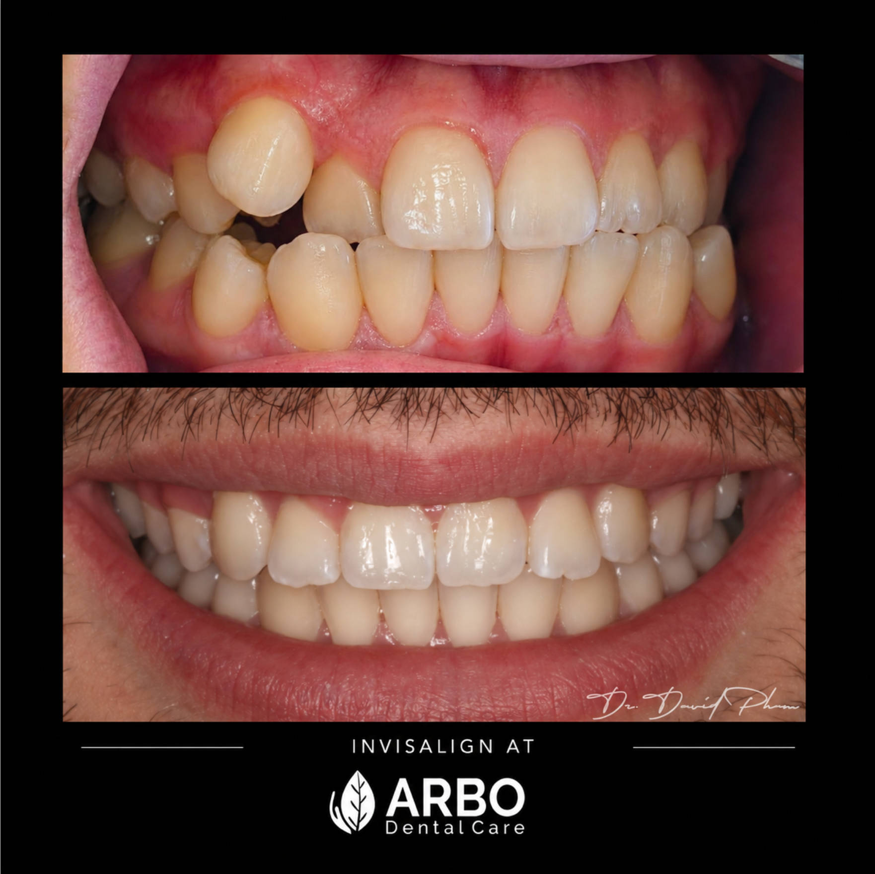 Invisalign in Bradford West Gwillimbury - Arbo Dental Care blog