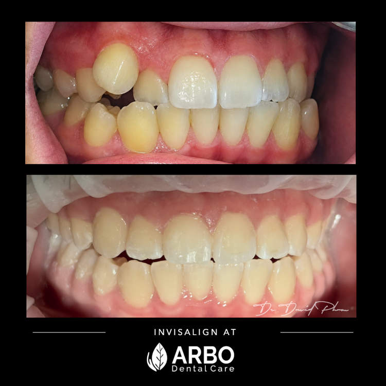 Invisalign in Bradford West Gwillimbury - Arbo Dental Care blog