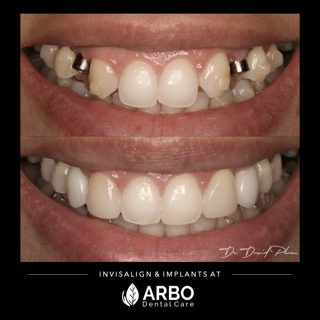 Invisalign, Implants, Cosmetic Dentistry in Bradford - Arbo Dental Care blog