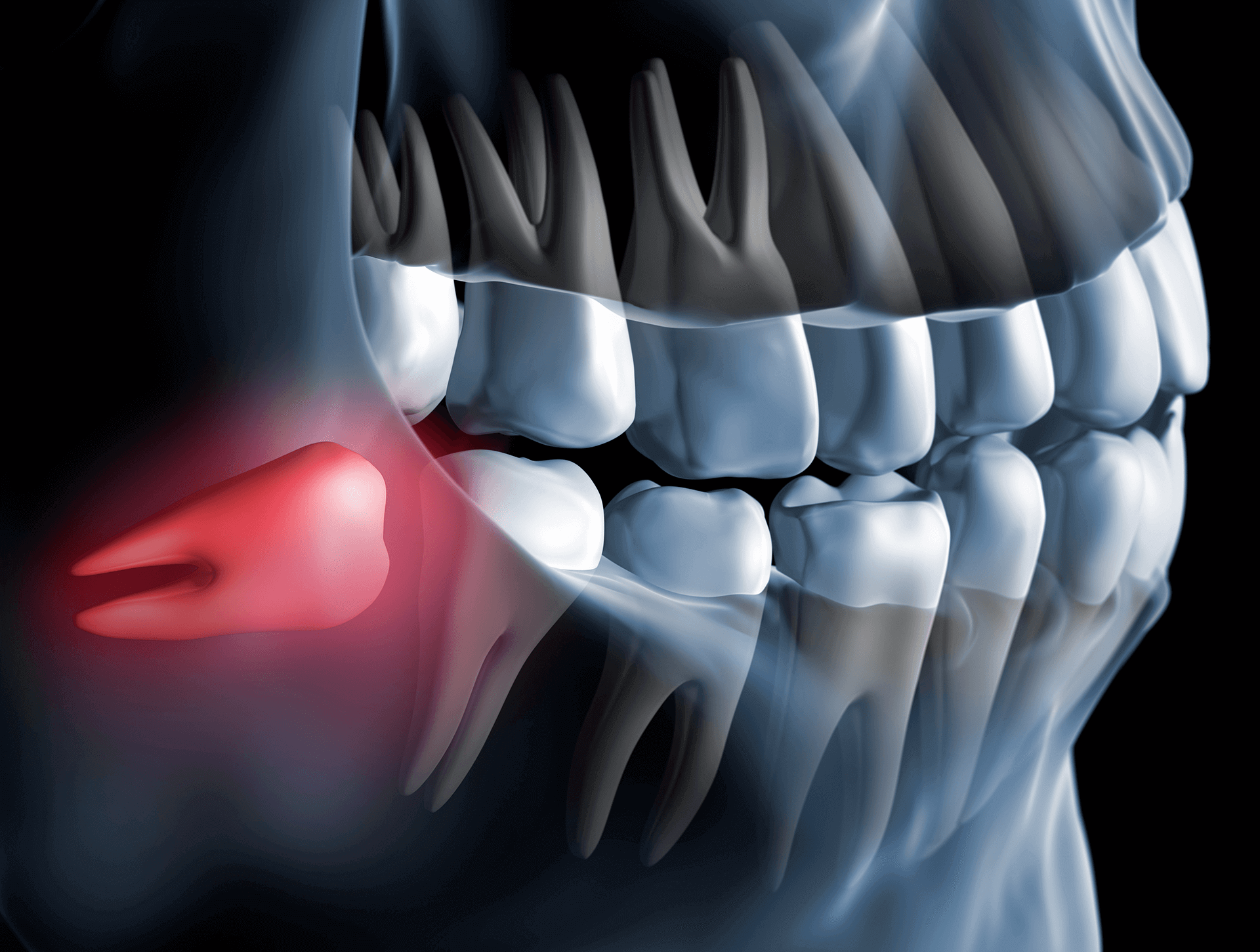 Wisdom Tooth Extractions