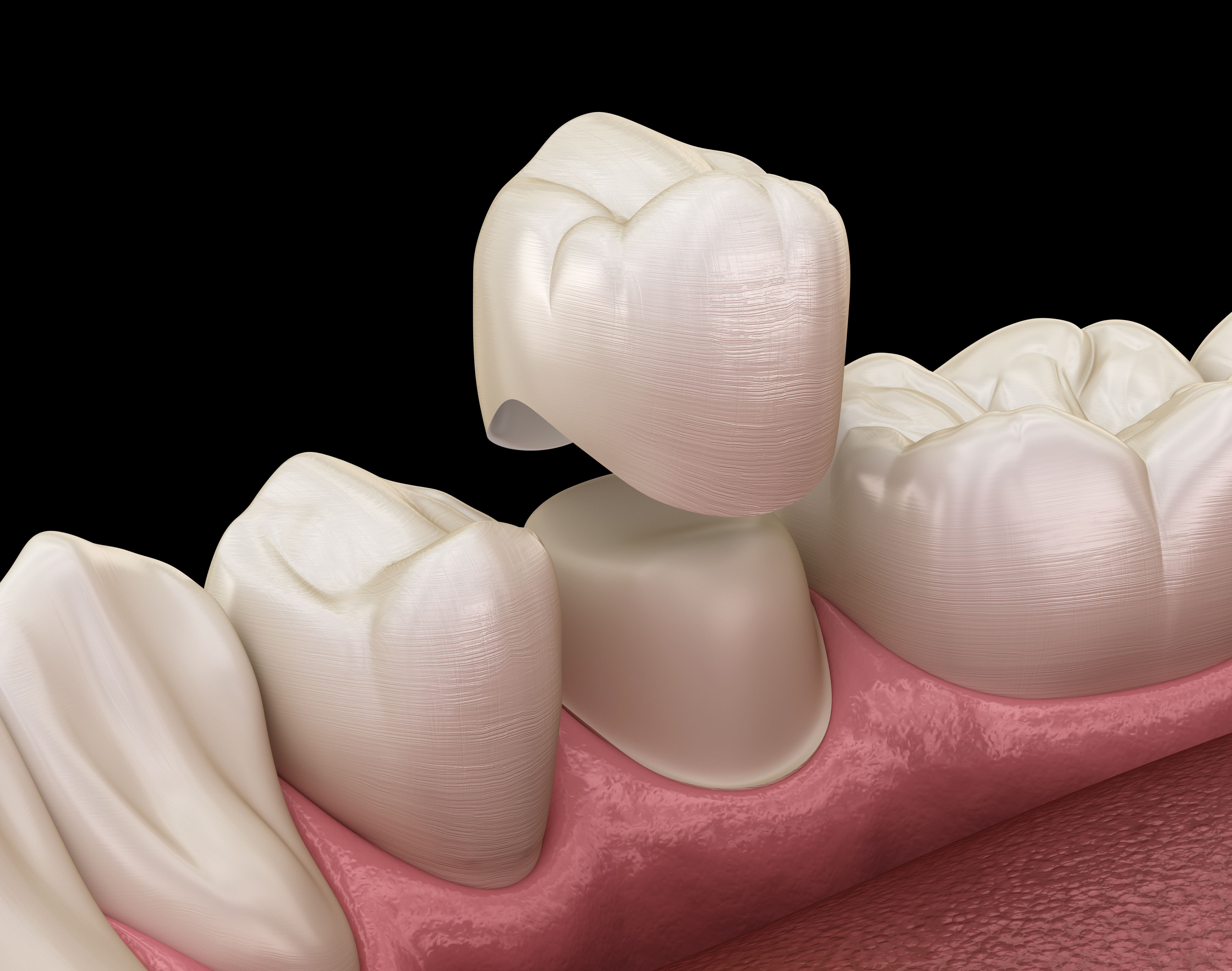 Same Day Dental Crowns - One Appointment